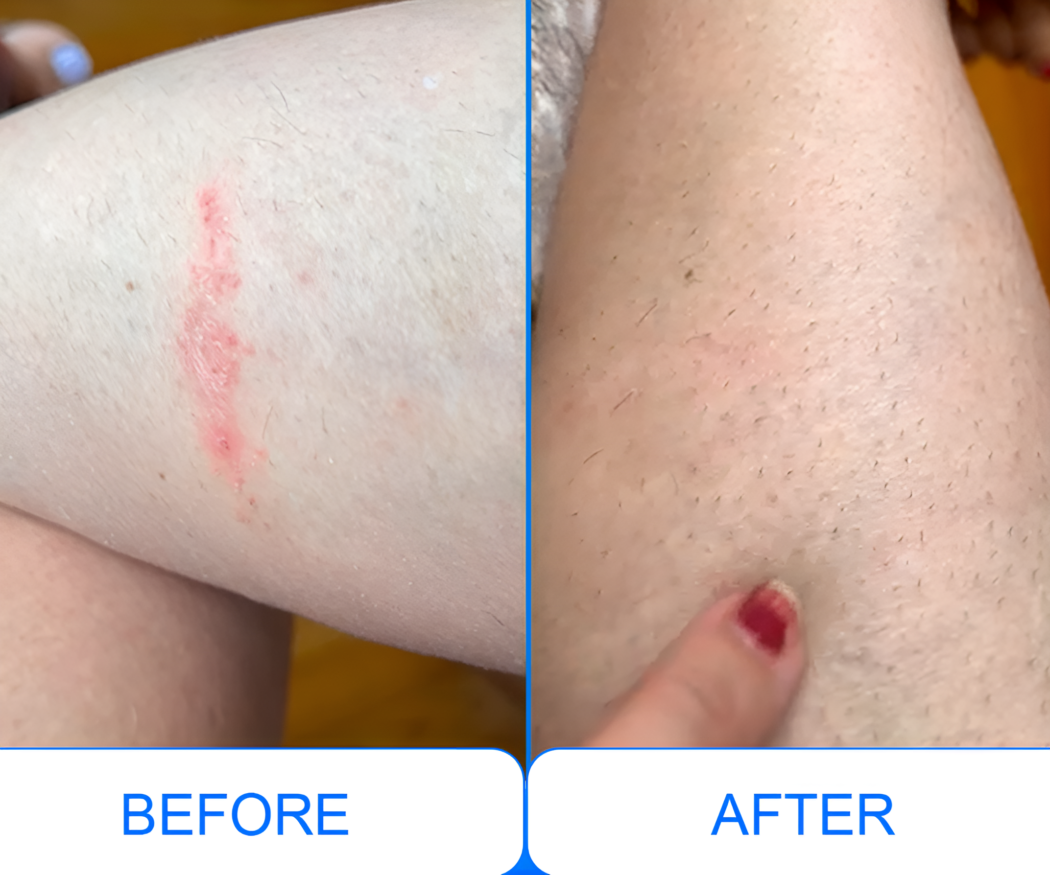 Portable UVB Light Therapy Lamp | Narrowband UVB for Psoriasis Relief