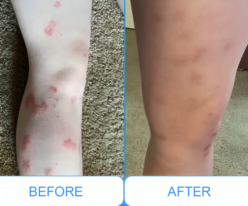 Portable UVB Light Therapy Lamp | Narrowband UVB for Psoriasis Relief